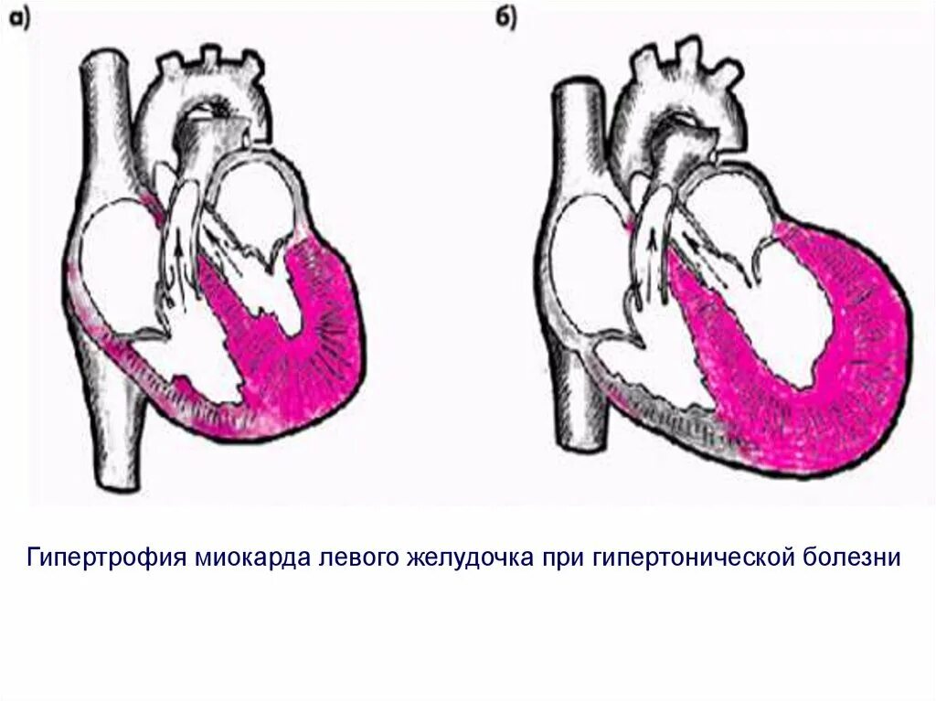 Гипертрофия миокарда лж что это. Гипертоническая болезнь и гипертрофия левого желудочка. Гипертрофия миокарда левого желудочка. Гипертрофия миокарда левого желудочка при гипертонической болезни. Гипертрофия левого желудочка при артериальной гипертензии.