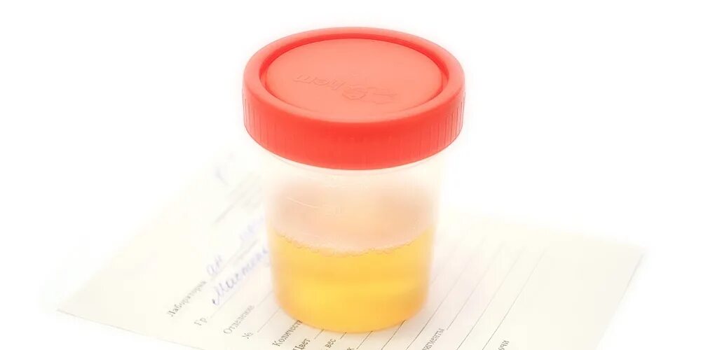 Баночка с мочой. Биохимический анализ мочи норма. Общий анализ мочи показатели нормы у женщин. Полная моча. Прозрачность мочи в норме и при патологии.