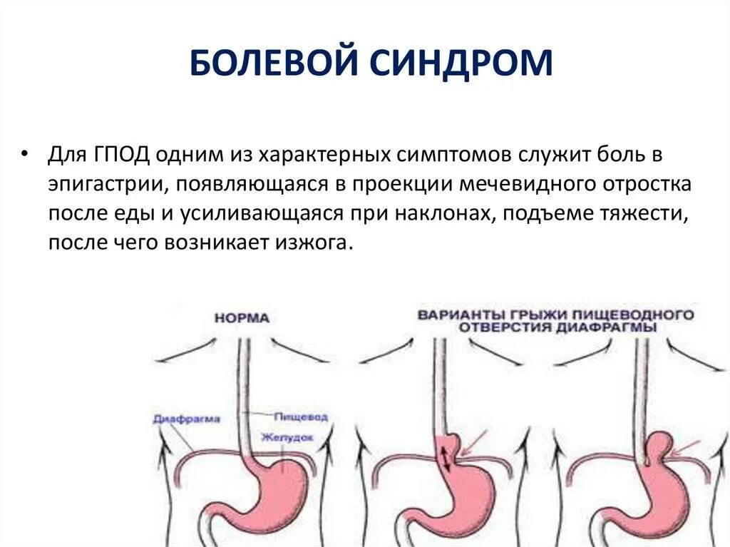 Почему грыжа пищевода