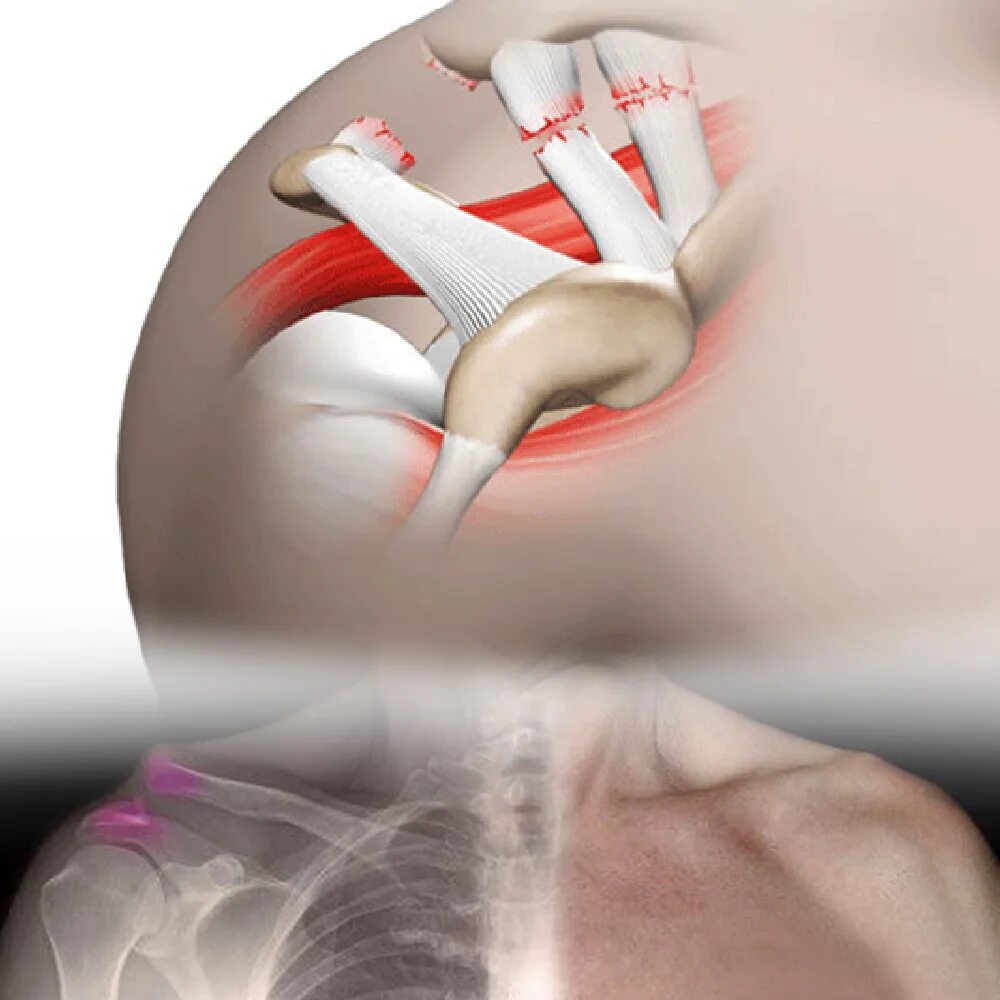 Разрыв сочленений. Акромиально-ключичный сустав травма. Разрыв акромиально-ключичного сочленения. Разрыв связок акромиально-ключичного сочленения. Разрыв акромиально плечевого сустава.