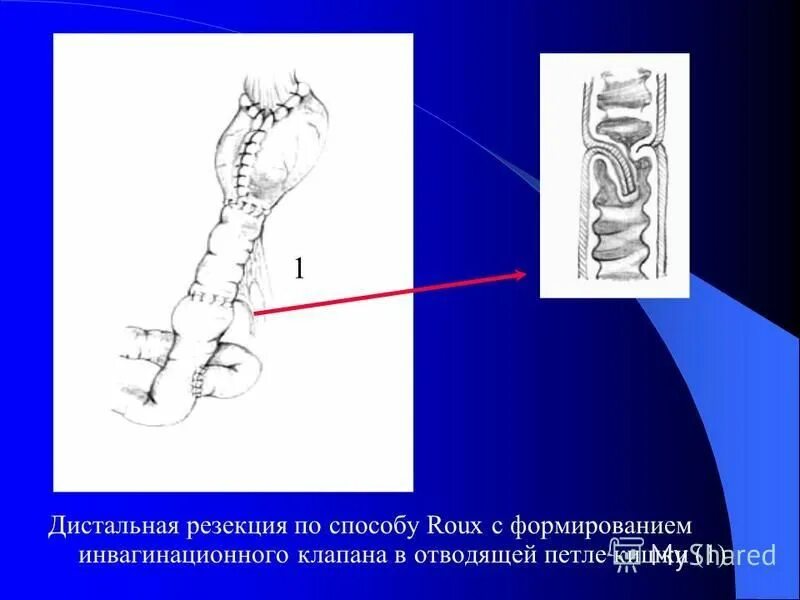 Расширение петель кишечника. Петелиь кишки. Инвагинационный анастомоз по Витебскому. Дистальный край резекции прямой кишки.