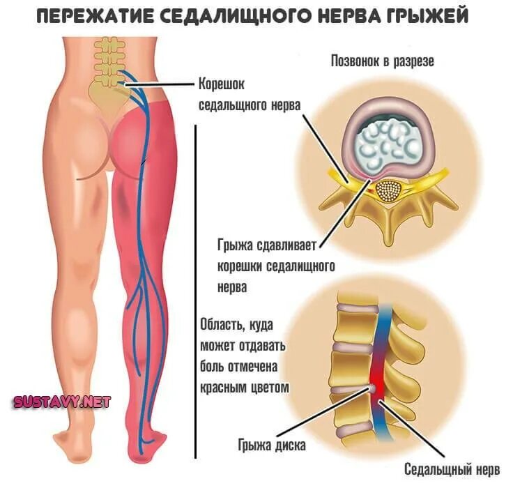 Боли в пояснице защемление нерва лечение. Сидалеч седалищный нерв. Схема защемления седалищного нерва. Седалищный нерв анатомия схема. Защемление сидальческий нерв симптомы.