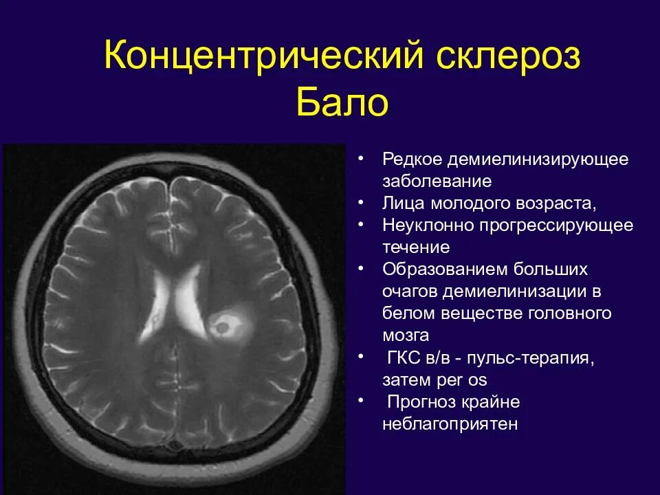 Очаги демиелинизации головного мозга на мрт. Концентрический склероз балло. Демиелинизирующий процесс. Очаги демиелинизации головного мозга что это такое. Признаки демиелинизирующего поражения