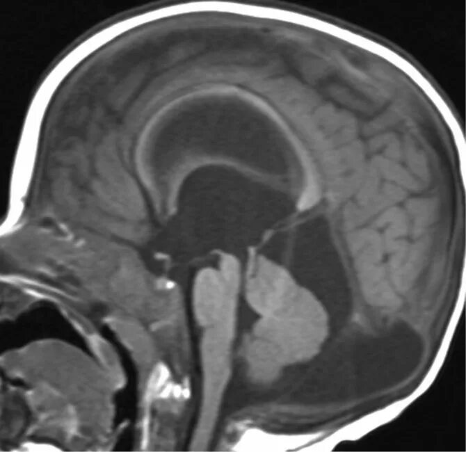 Киста головного мозга последствия. Ретроцеребеллярная арахноидальная киста кт. Тривентрикулярная гидроцефалия. Ретроцеребеллярная арахноидальная киста в головном мозге. Расширение нижней ретроцеребеллярной цистерны.