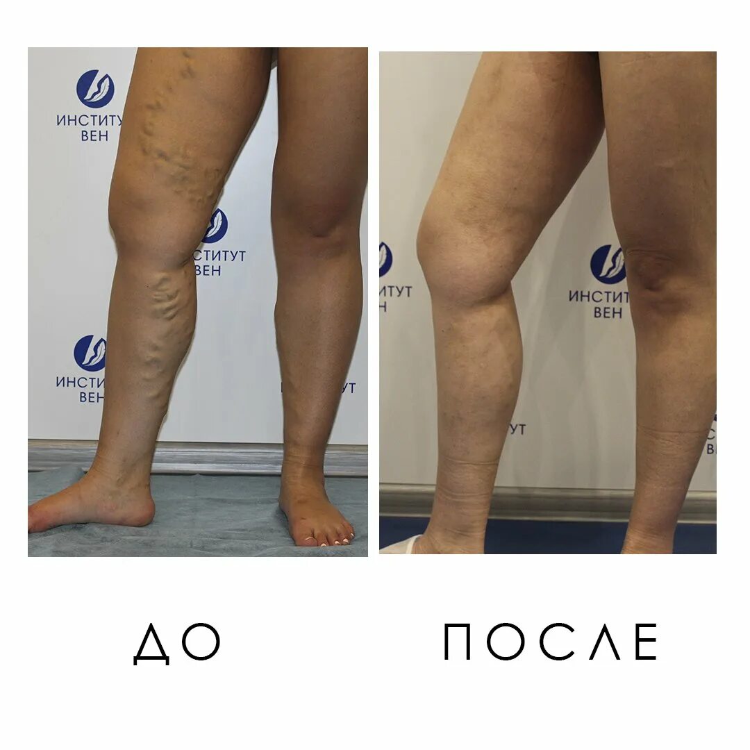 Рекомендации после операции вен. Эндовенозная лазерная коагуляция (ЭВЛК). Операция варикоза Лазар. Лазерная операция на варикоз. Операция варикоза до и после.