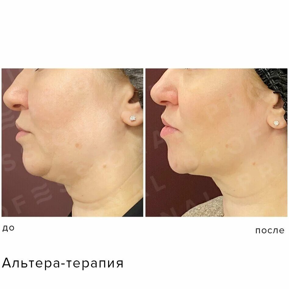 Процедуры альтера отзывы. Альтера-терапия до и после. альтера до и после фото. кожа без эффекта сглаживания.