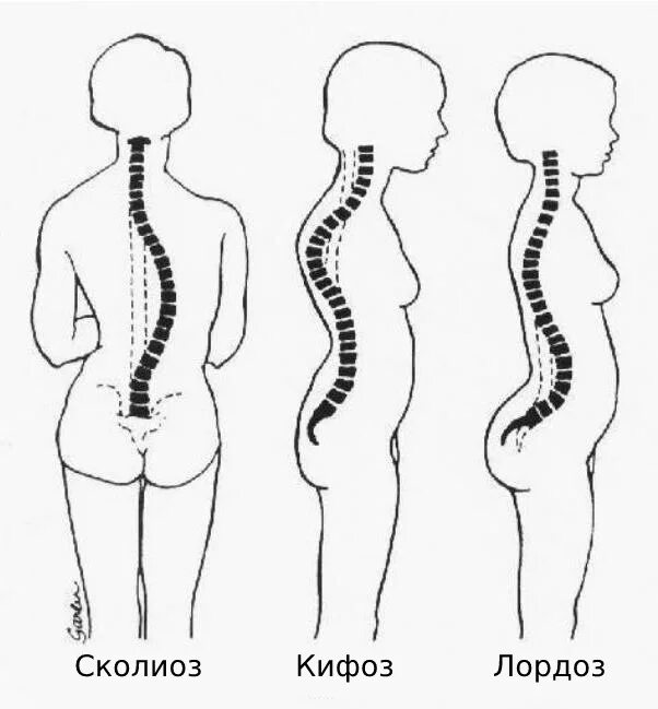 Кифоз лордоз и сколиоз позвоночника. Искривление позвоночника лагдох сктфох. Искривление позвоночника лордоз кифоз сколиоз. Лордоз кифоз сколиоз у детей.