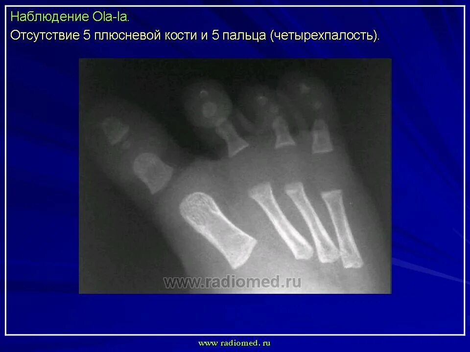 Аномалии костей. Эктродактилия аномалия конечностей. аномалии развития костей. аномалии развития костей кисти. аномалии развития костей стопы.