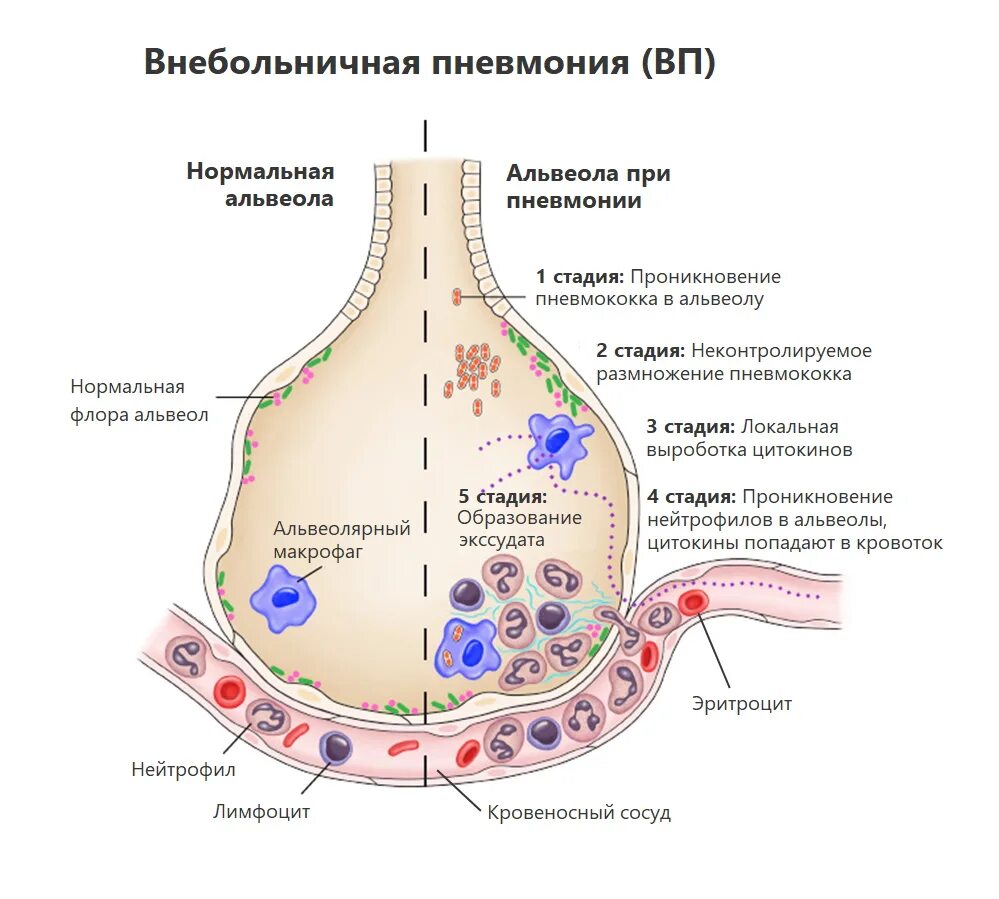 Патогенез внебольничной пневмонии схема. Патогенез вне больничной пневмонии. Патогенез пневмонии патофизиология. Патогенез внебольничной пневмонии. Развитие ковид