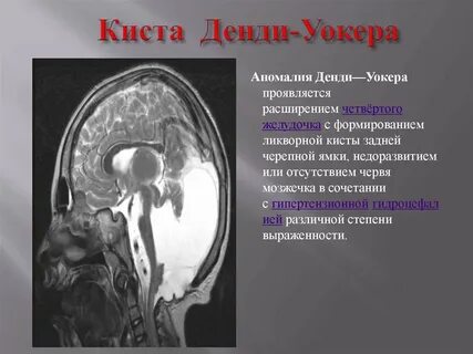 Аномалия денди уокера