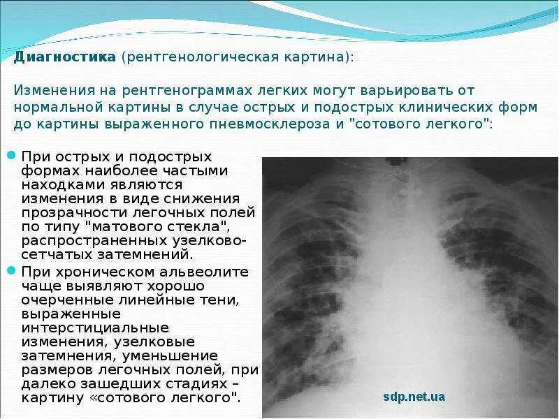 Пневмосклероз рентген описание. Рентген картина фиброза легких. Описание фиброза на рентгене. Рентген признаки пневмофиброза.