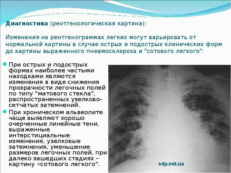 Диагноз фиброз легких. Что такое плевропульмональный фиброз. диффузный интерстициальный пневмосклероз. диффузный пневмосклероз диагноз. пневмофиброз s5 правого лёгкого.