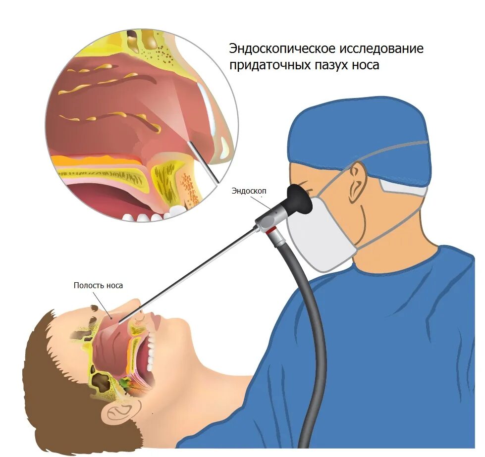 Полость страдать. Эндоскопические методы исследования полости носа. Эндоскопия пазухов носа. Эндоскопический осмотр полости носа. Эндоскопическое исследование полости носа и носоглотки.