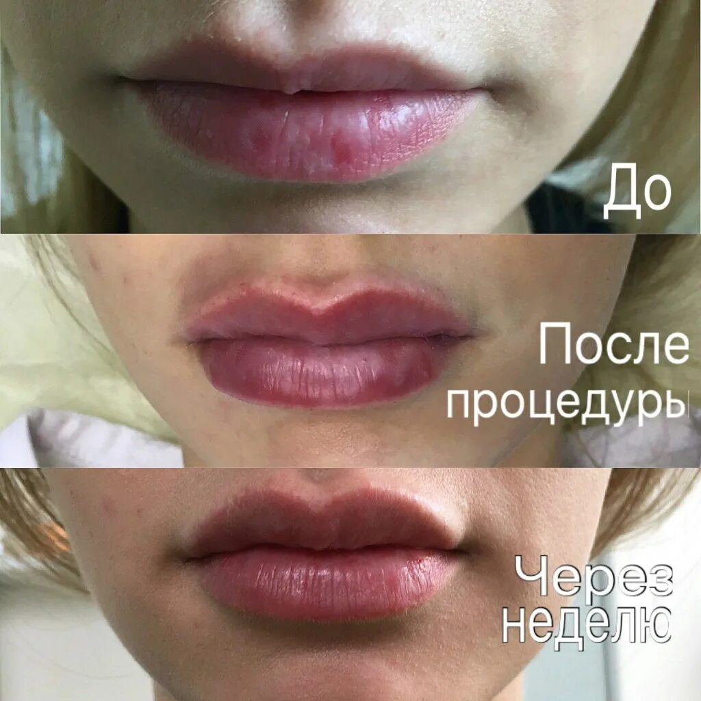 Лонгидаза для губ. Лонгидаза уколы в губы отек. Лонгидаза в косметологии. Губы после лонгидазы фото. Лонгидаза для губ.