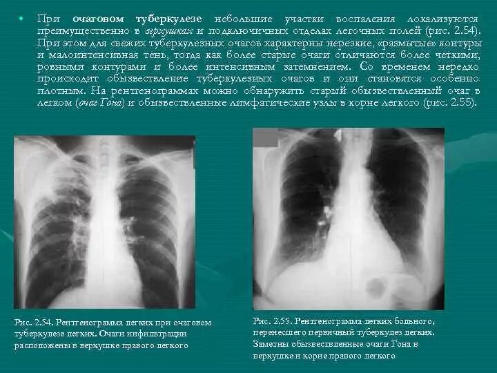 Очаговая форма туберкулеза. Очаговый туберкулез описание рентгенограммы. Очаговый туберкулез легких рентген описание. Очаговый туберкулез легкого рентген. Очаговый туберкулёз лёгких рентген.