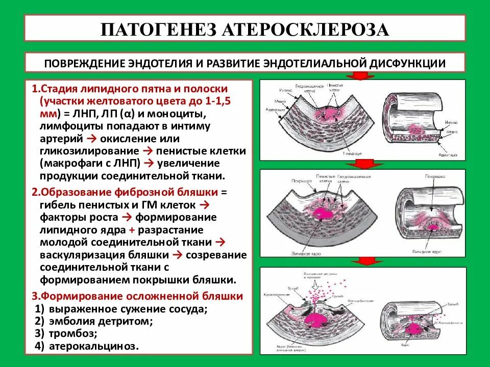 Причины развития атеросклероза. Этиология атеросклероза патофизиология. повреждение эндотелия сосудов причины. формирование атеросклеротической бляшки патогенез. патогенез атеросклероза патофизиология.