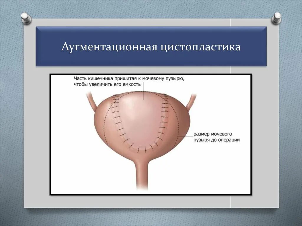 Удаление мочевого пузыря сколько. Аугментационная цистопластика. Цистопластика мочевого пузыря. Пластика мочевого пузыря. Аугментация мочевого пузыря.