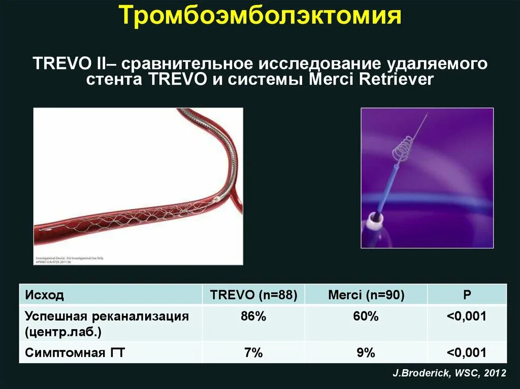 Система стента. Прямая тромбоэмболэктомия. Катетер для тромбоэмболэктомии. Хирургическая тромбоэмболэктомия.