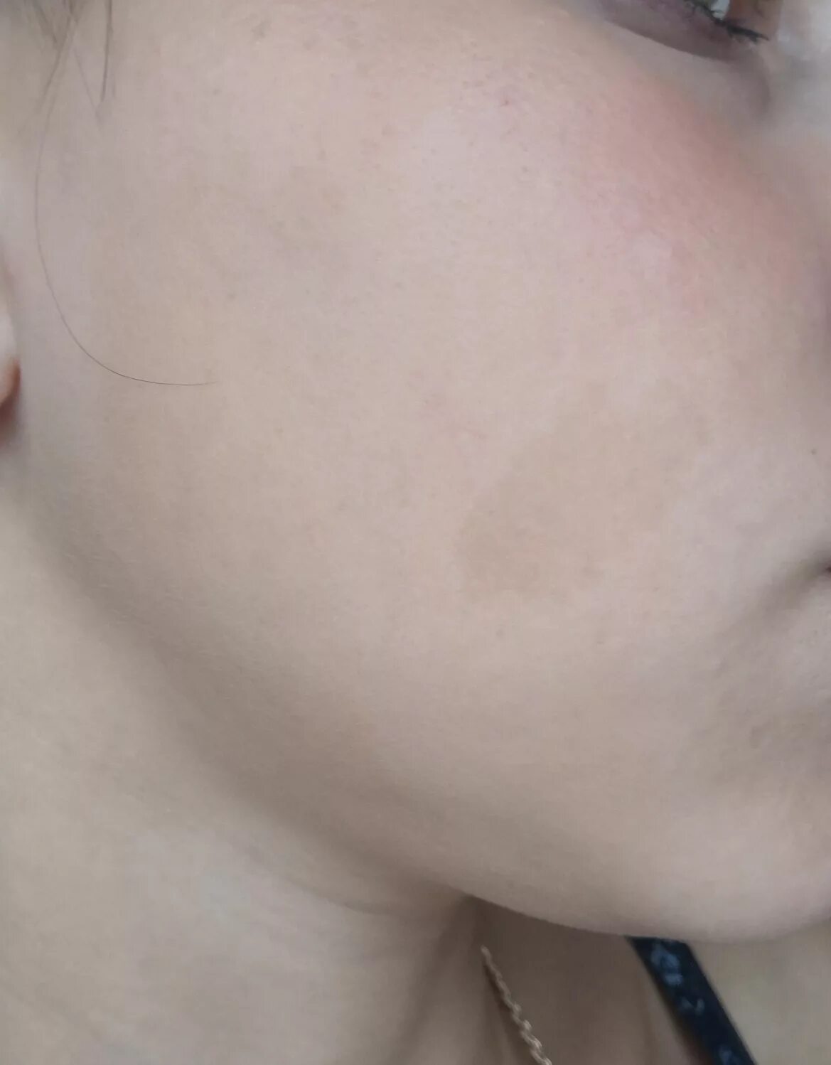 На щеке пятно родимое а на висках. Сосудистое родимое пятно. Келси картер певица. Левша портрет героя. Невус волосистой части головы.