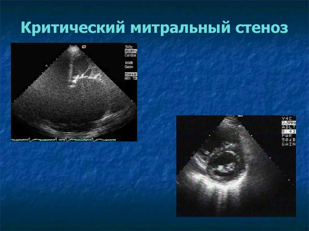 Дегенерация митрального клапана. Стеноз митрального клапана на УЗИ. Критический митральный стеноз. Критический стеноз митрального клапана. Дегенеративный митральный стеноз митрального.