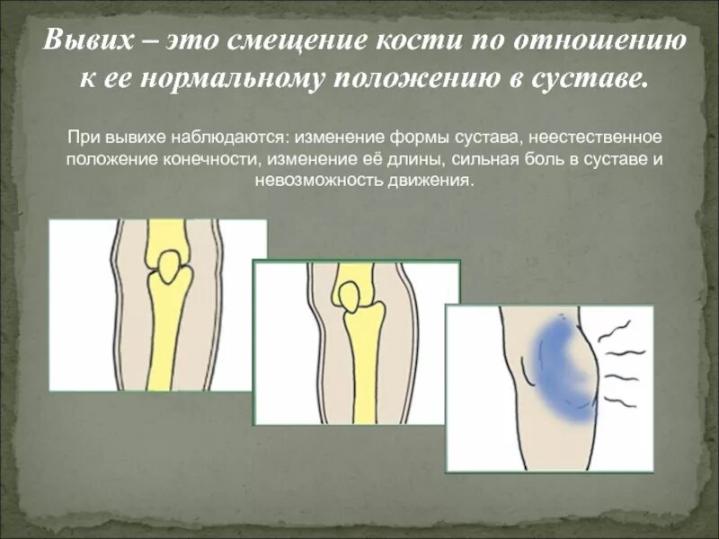 Смещение кости по отношению к ее нормальному положению в суставе это. Смещение костей в суставе