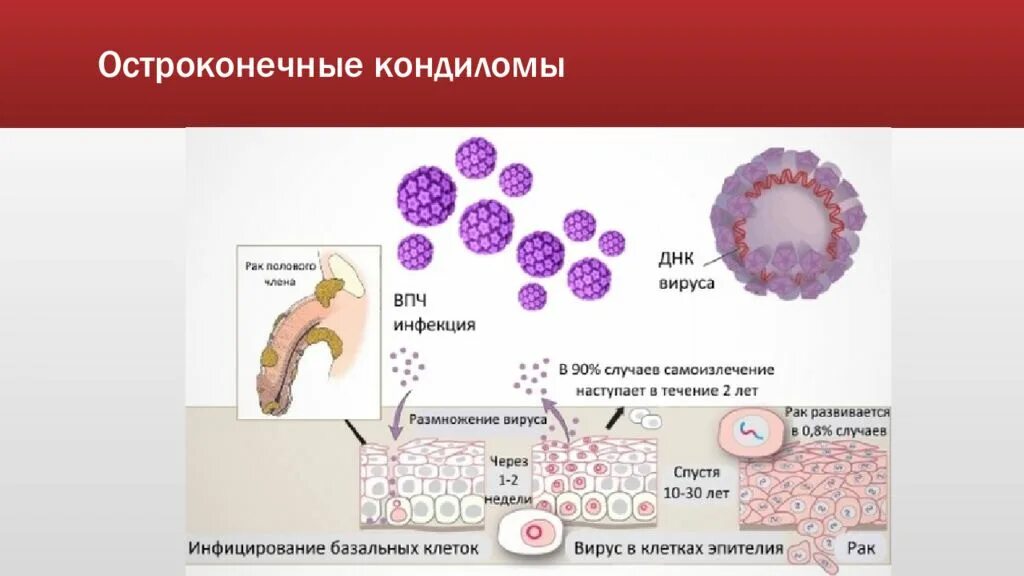 Остроконечные кондиломы НПО. Папилломавирусная инфекция 66 Тип. Рак головки члена