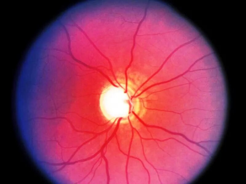 Атрофия зрительного нерва у детей. Ишемическая оптикопатия зрительного нерва. Ишемическая нейропатия зрительного нерва. Патологии зрительного нерва глаукома. Нейропатия зрительного нерва Лебера.