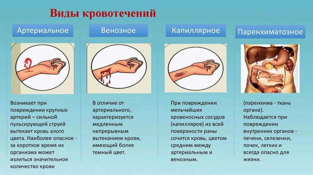 Кровотечения делятся на. Виды кровотечений по виду поврежденного сосуда. Кровотечения бывают следующих видов:.