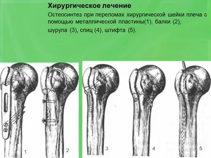Операция шейки плеча