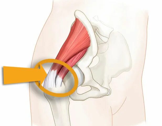 Тендинит сухожилия тазобедренного сустава. Тендинит сухожилий ягодичных мышц. Тендинит сухожилий ягодичных мышц тазобедренных суставов. Тендинит сухожилия надколенника.