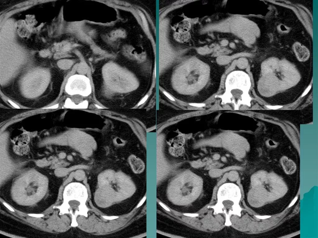 Миелолипома надпочечника кт. Аденома надпочечника кт. Псевдокиста надпочечников кт. Гиперперфузия надпочечников на кт. Аденома надпочечника у мужчин что это