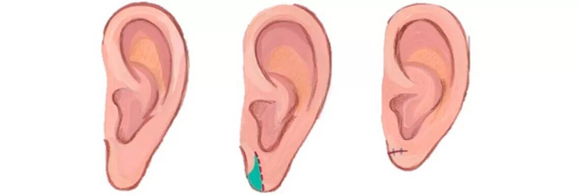 Операция отопластика мочки ушей. Пластика мочки уха (2 категория сложности). Пластика мочки ушной раковины.