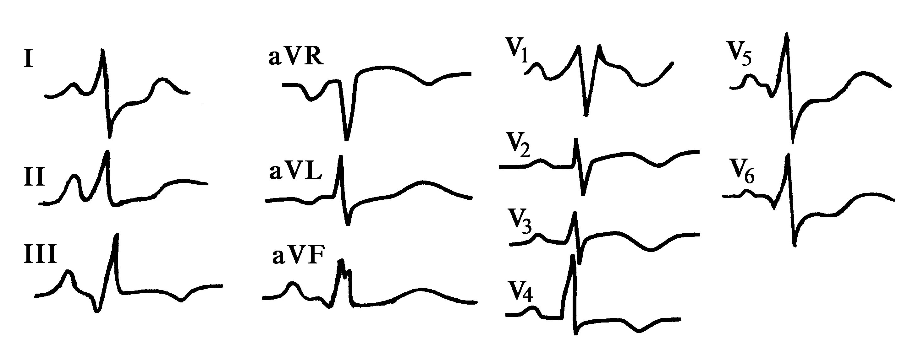 Изменение комплекса qrs