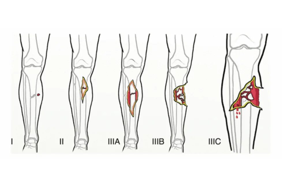 Открытая трещина. Классификация открытых переломов Gustilo-Anderson. Gustilo Anderson классификация. Классификация открытых переломов (Gustilo-Anderson, 1976). Перелом Gustilo Anderson 2.