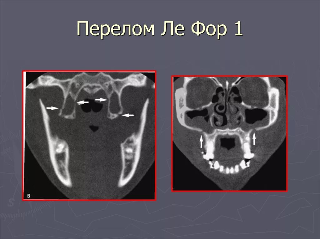 Ле фор 1. Перелом челюсти по лефор 1. перелом верхней челюсти по лефору 1. лефор переломы верхней челюсти. перелом верхней челюсти лефор 3.