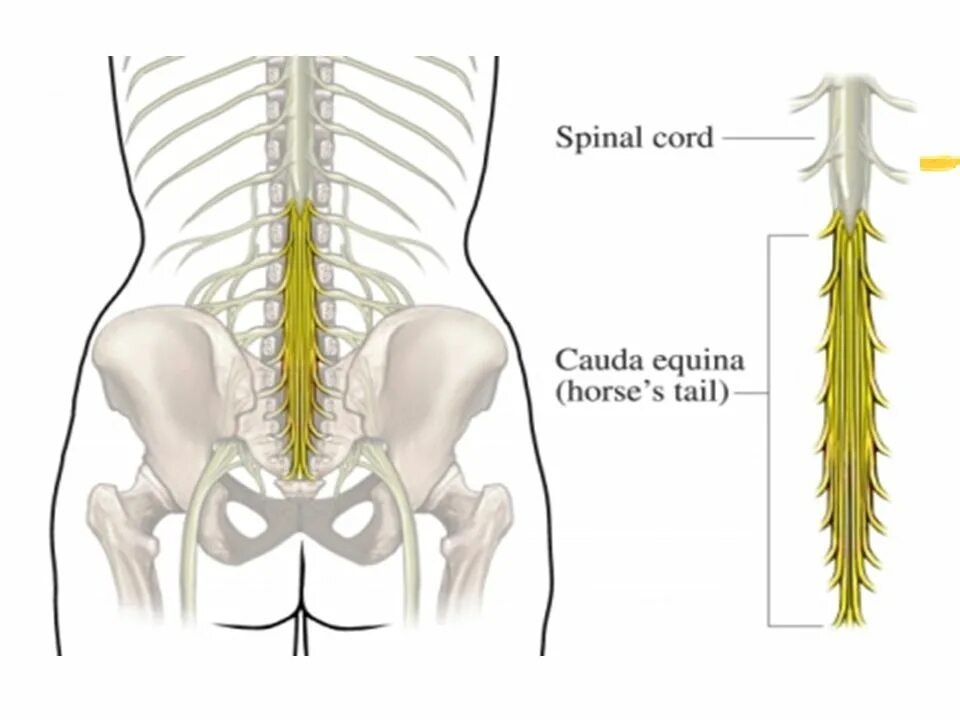 Корешковые нервы в пояснице. Пояснично-крестцовый отдел спинного мозга. Седалищный нерв и конский хвост. Конский хвост кауда эквина. Спинной мозг конский хвост седалищный нерв.
