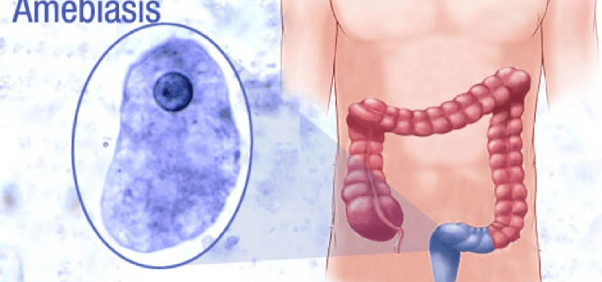 Заболевание вызванное амебами. Заболевание вызванное амебами. Заболевание вызванное амебами. Амёба дизентерийная среда обитания. Заболевание вызванное амебами.