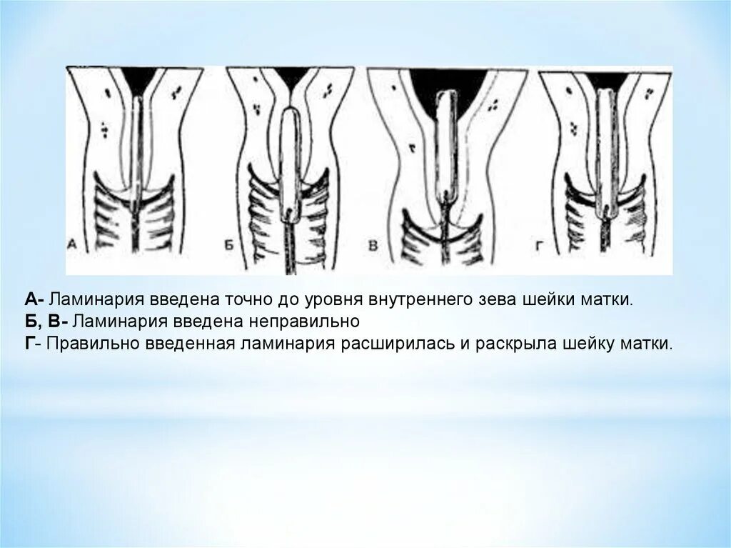 Ламинарии для стимуляции шейки матки. Палочки ламинарии для стимуляции. Палочки водоросли для раскрытия матки. Ламинарии для расширения шейки матки.