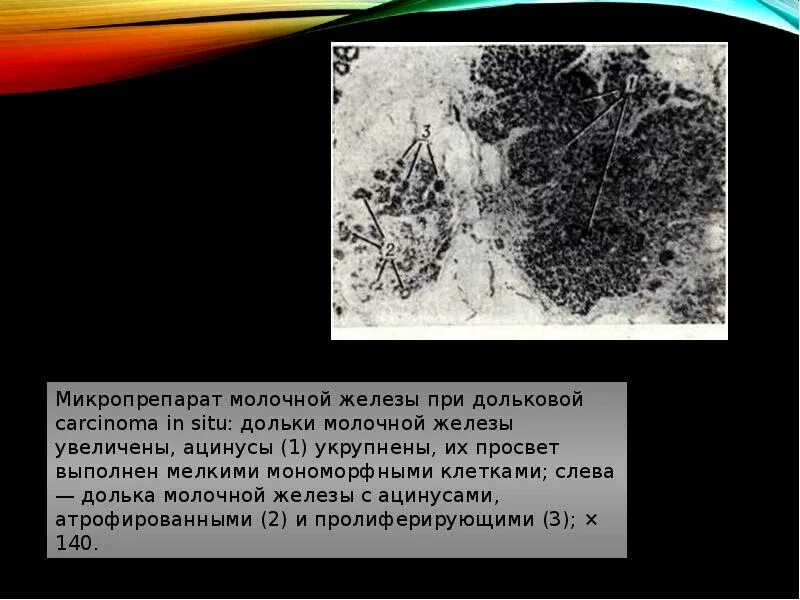 Карцинома in situ методы верификации. Лобулярная карцинома in situ (неинвазивная). Лобулярная карцинома in situ заключение. Рак in situ шейки