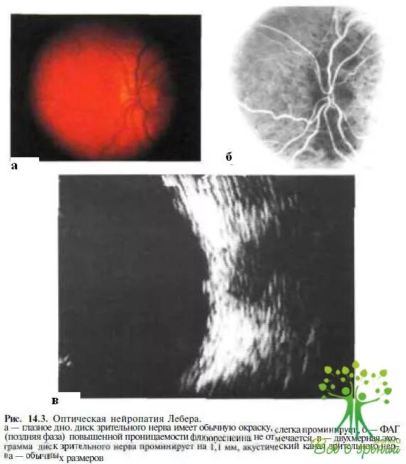 Атрофия зрительного нерва Лебера. Нейропатия зрительного нерва Лебера. Атрофия зрительного нерва Либеро. Наследственная оптическая нейропатия LHON Лебера. Нейропатия зрительных