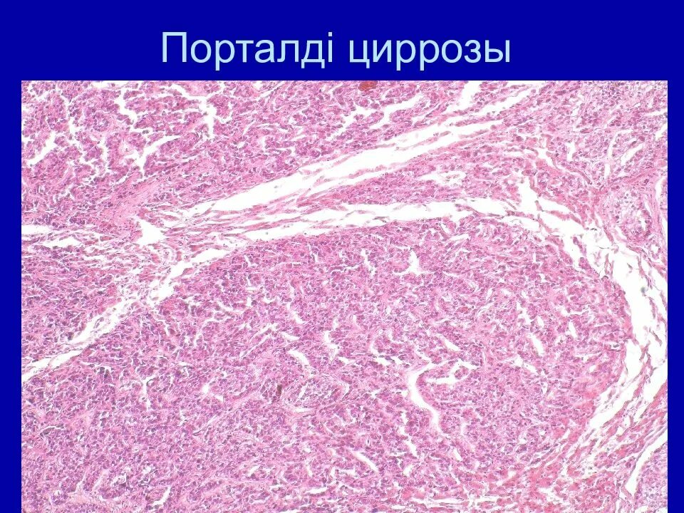 Печень портальный. Портальный цирроз печени патанатомия. алкогольный монолобулярный портальный цирроз печени микропрепарат. постнальный цирроз печени микропрепарат. постнекротический цирроз печени патанатомия.