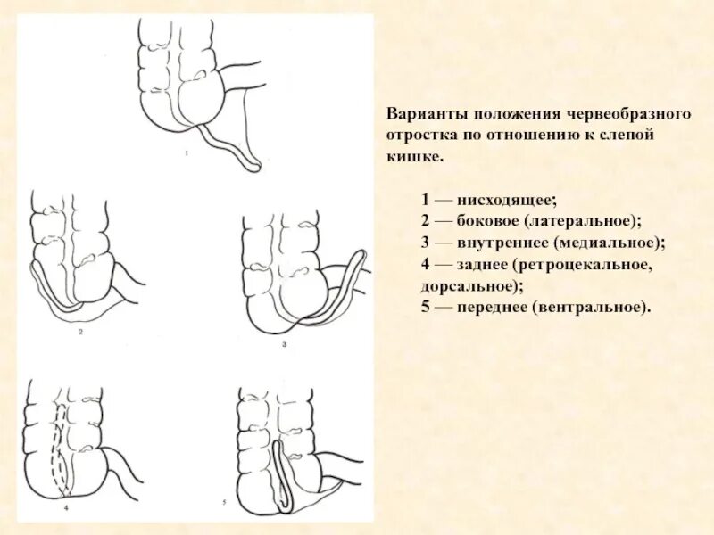 Положение при аппендиците. Варианты положения червеобразного отростка. Типичное расположение червеобразного отростка. Скелетотопия червеобразного отростка. Положение аппендикса по отношению к слепой кишке.