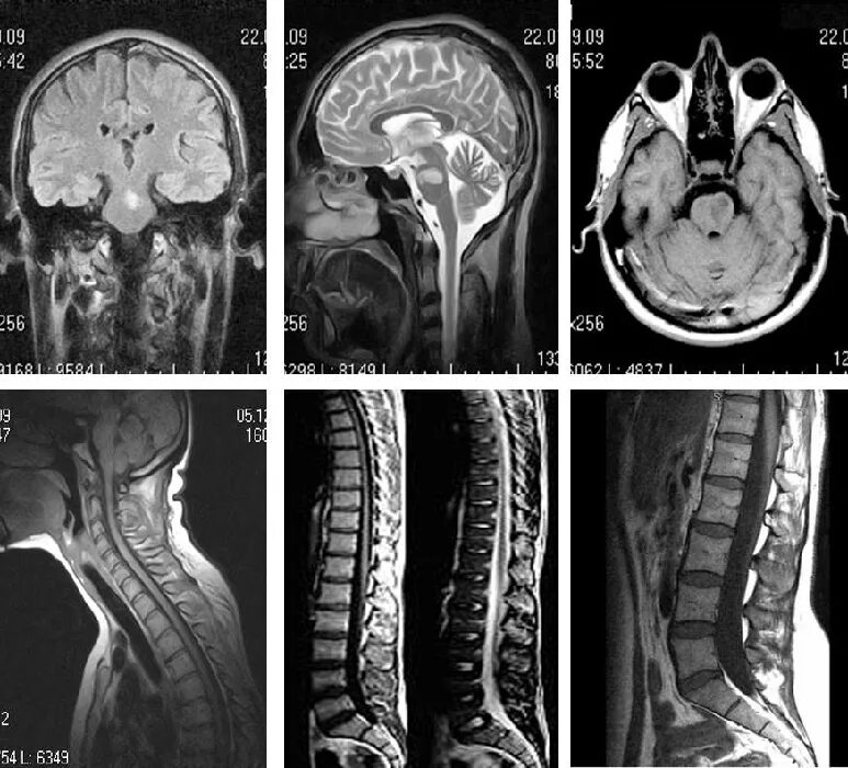 Зачем назначают мрт. Магнитно резонансная томография снимки. Мрт с2-с7. Спинной мозг снимок мрт. ЯМР томография спинного мозга.
