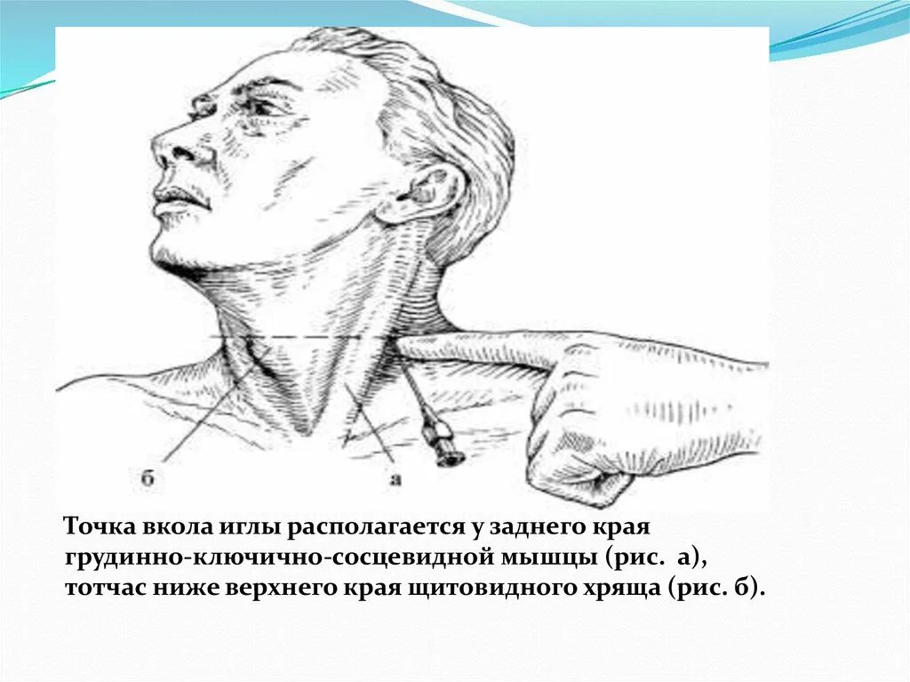 Блокада сплетения. Блокада плечевого сплетения по Куленкампфу. Блокада плечевого сплетения межлестничным доступом. Проводниковая анестезия по Куленкампфу. Проводниковая анестезия плечевого сплетения.