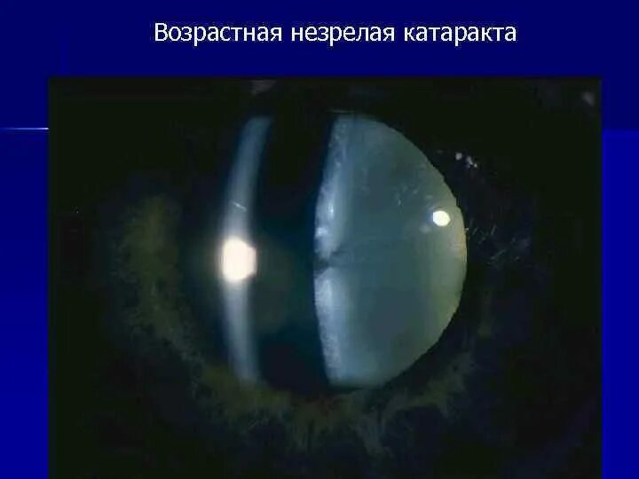 Возрастная катаракта. Возрастная катаракта