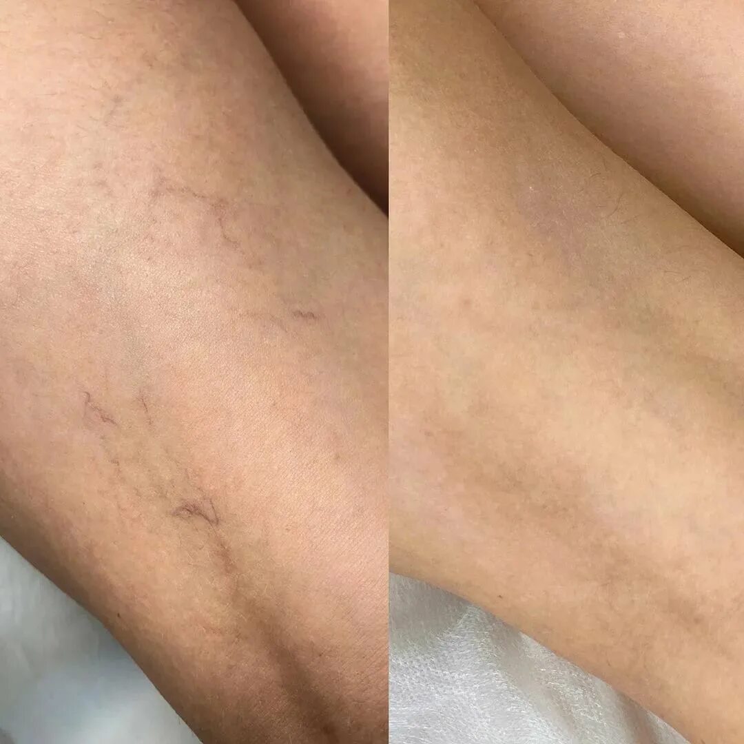 склеротерапия варикоз. удалить сетку на ногах. сеточки и звездочки на ногах варикоз. склеротерапия варикоз. сосудистые звездочки на ногах.