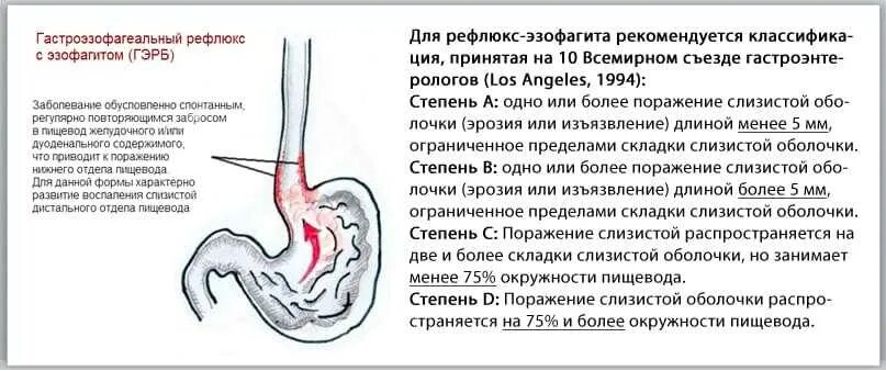 Можно ли глотать мокроту во время поста. Рефлюкс эзофагит и ГЭРБ отличие. Эрозивный гастрит рефлюкс эзофагит.