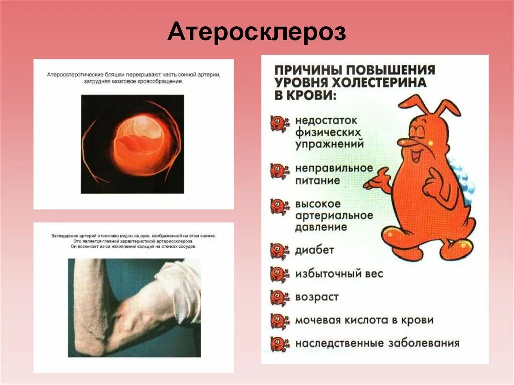 Атеросклеротическая болезнь сердца