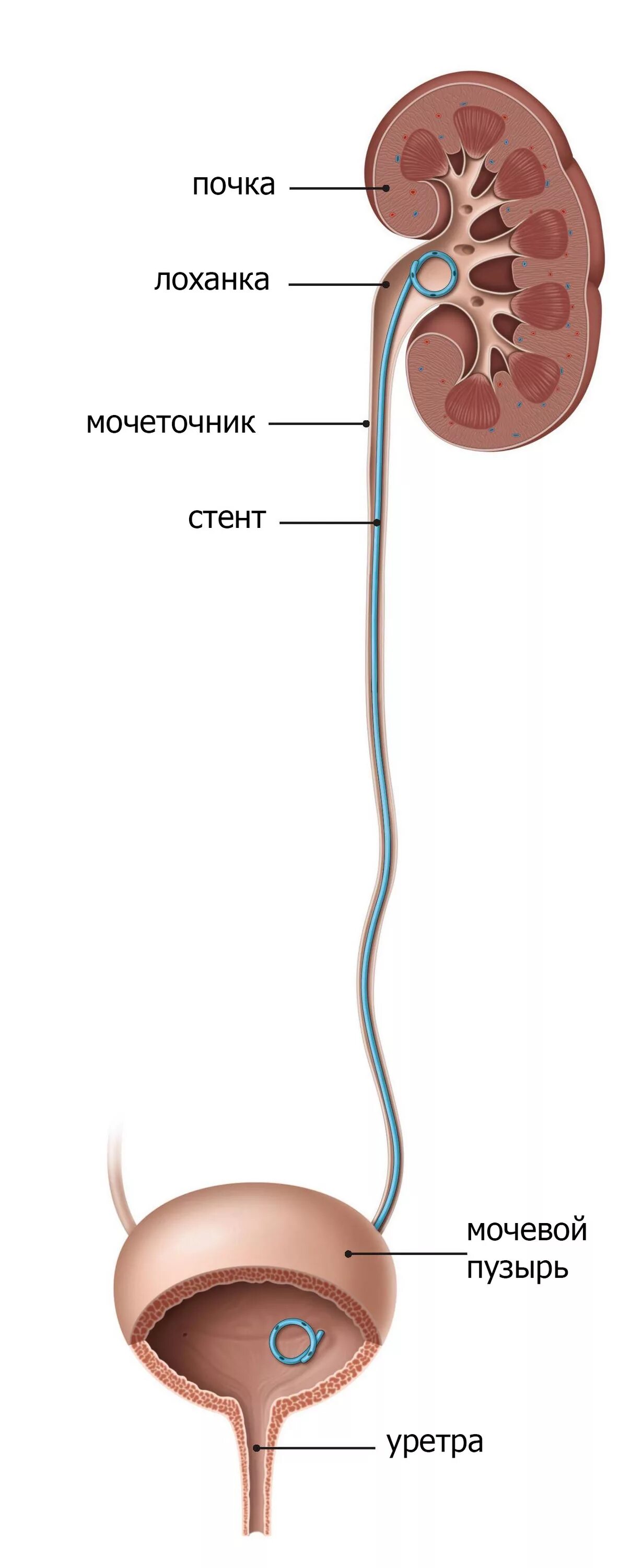 Мочеточник почечная лоханка мочеиспускательный канал мочевой пузырь. Стент в почке и камень в мочеточнике. Стент почка мочевой пузырь. Внутренний стент в мочеточнике. Лоханка мочеточник мочевой пузырь.