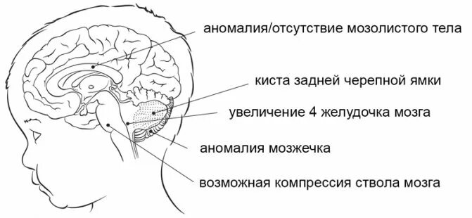 Мозжечок у плода норма. Гипоплазия мозжечка, аномалия Денди-Уокера. Аномалия головного мозга Денди Уокера. Вариант мальформации Денди Уокера мрт. Диагноз мальформация Денди Уокера.